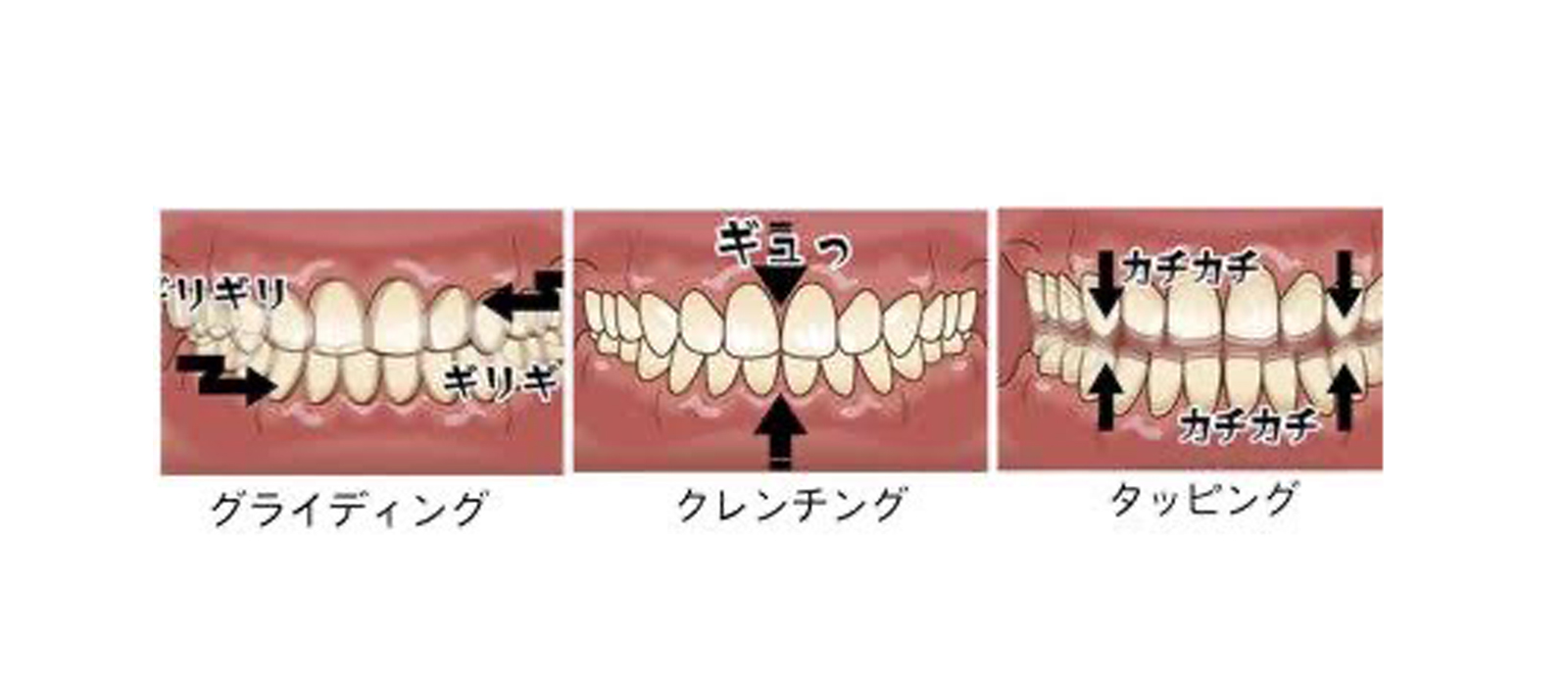 歯ぎしりの種類