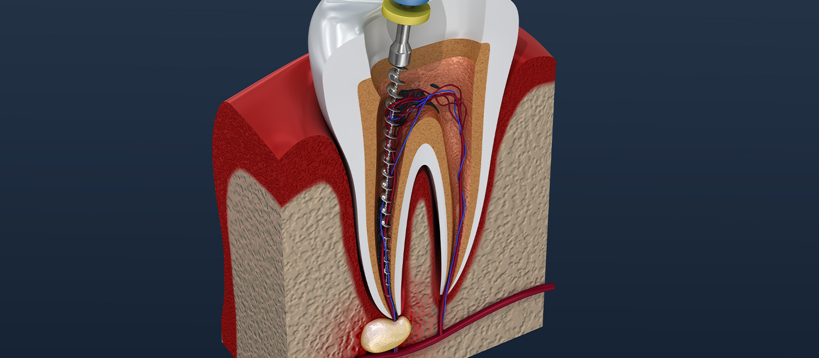 「歯の神経の治療」について