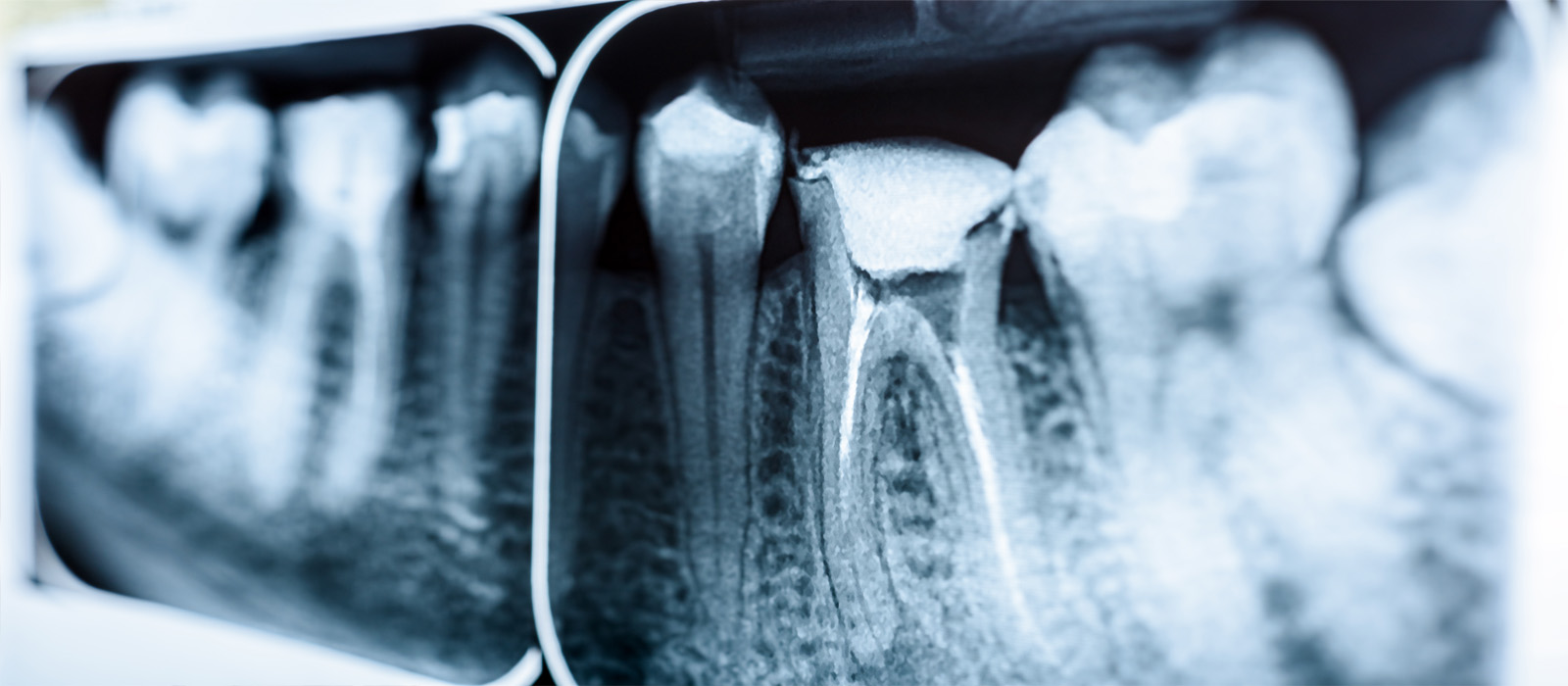 健康な骨の状態と歯周病の状態の比較