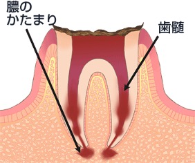 重度のむし歯