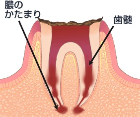 重度のむし歯