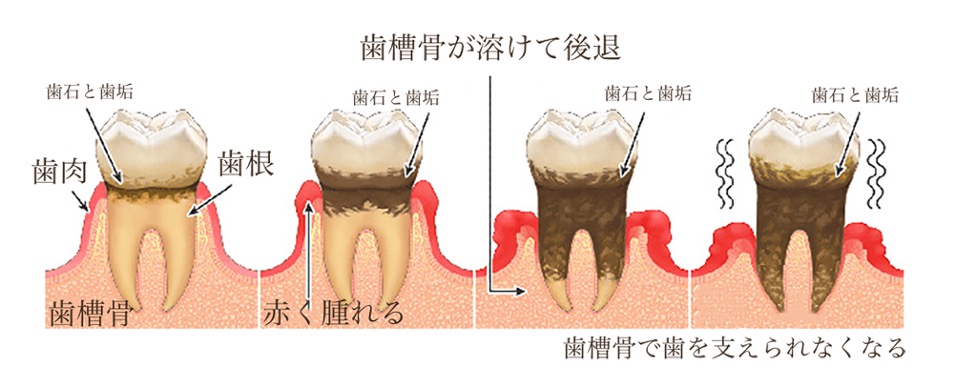 重度の歯周病