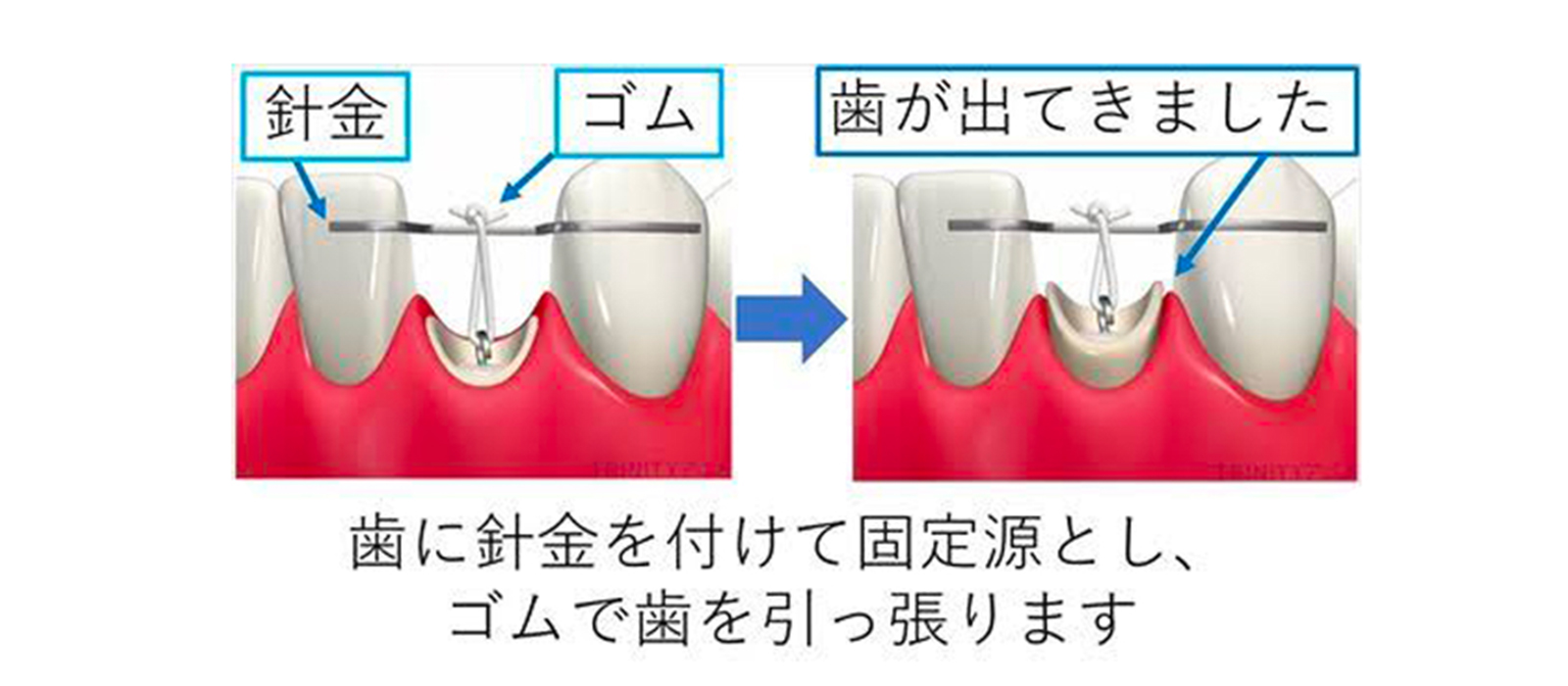 エクストルージョン