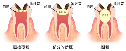 歯髄温存療法