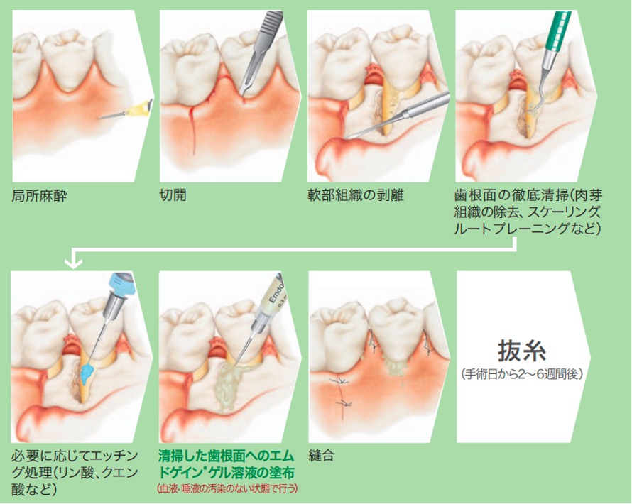 歯周再生療法