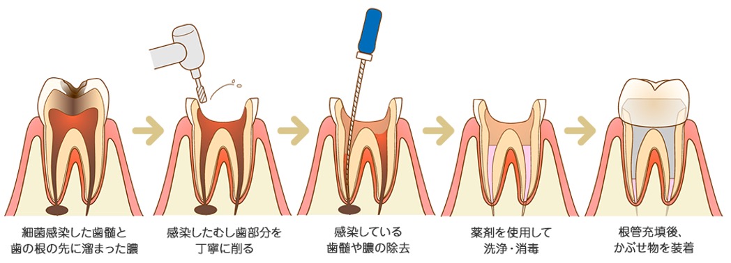 ゴムの交換