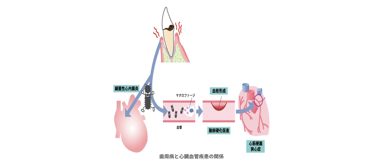 歯周病治療について