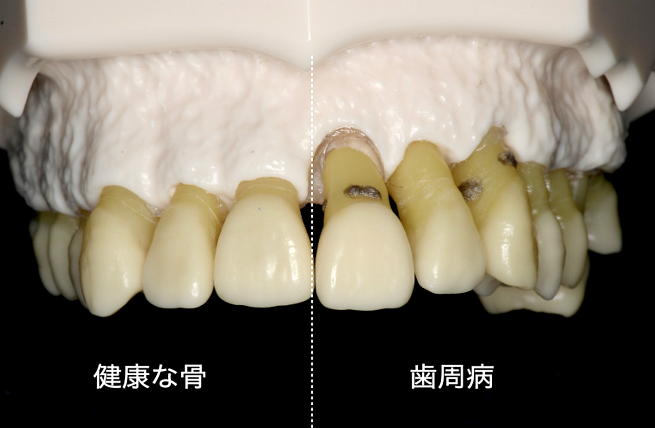 健康な骨の状態と歯周病の状態の比較