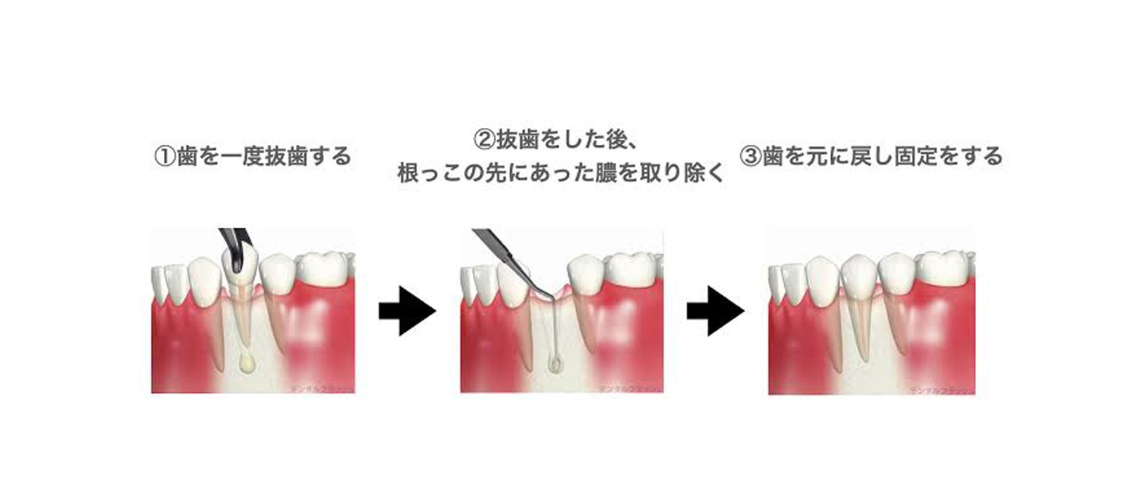 根管治療について