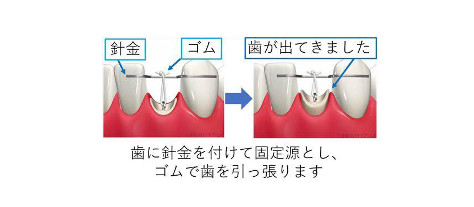 根管治療について