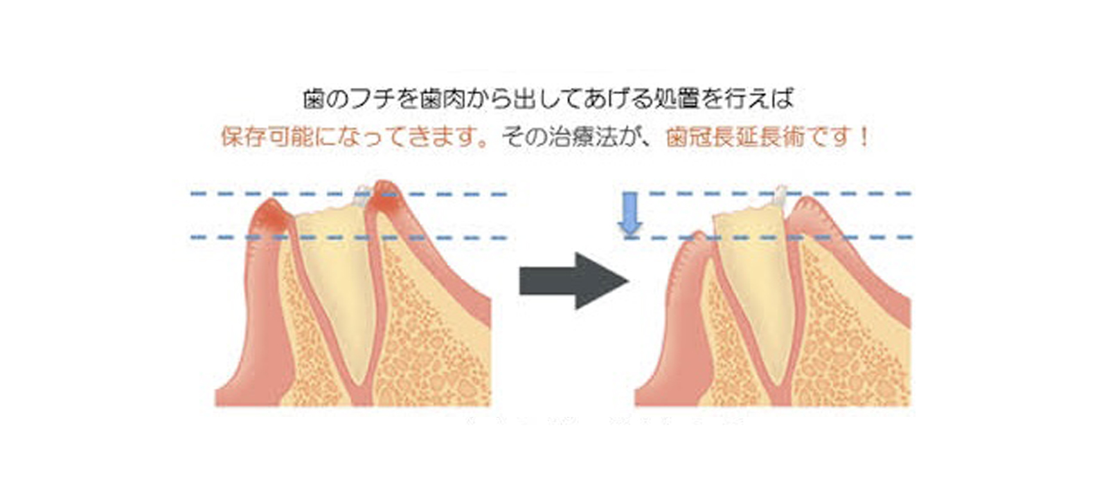 根管治療について